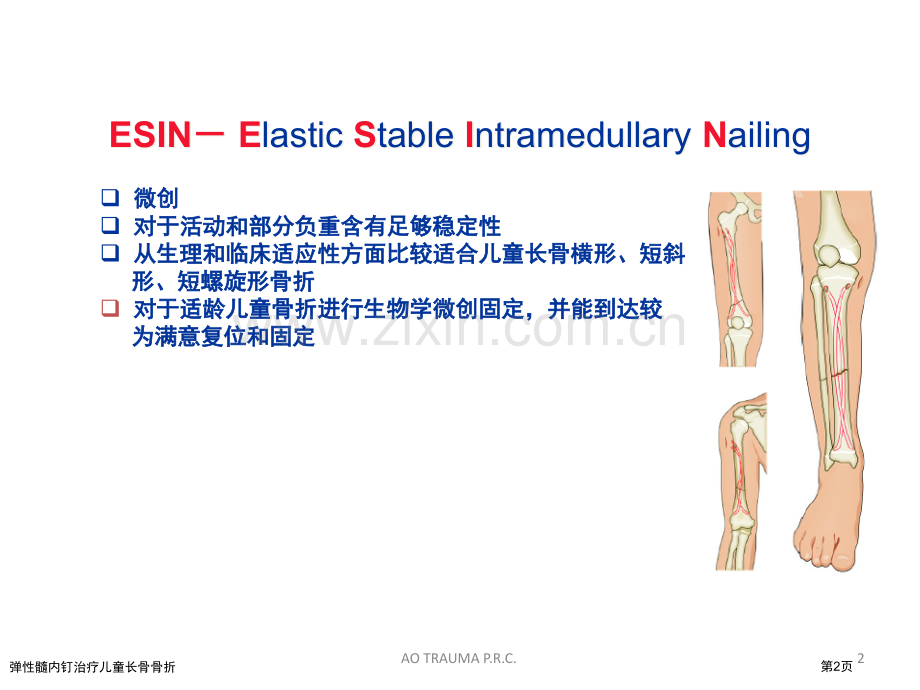 弹性髓内钉治疗儿童长骨骨折.pptx_第2页