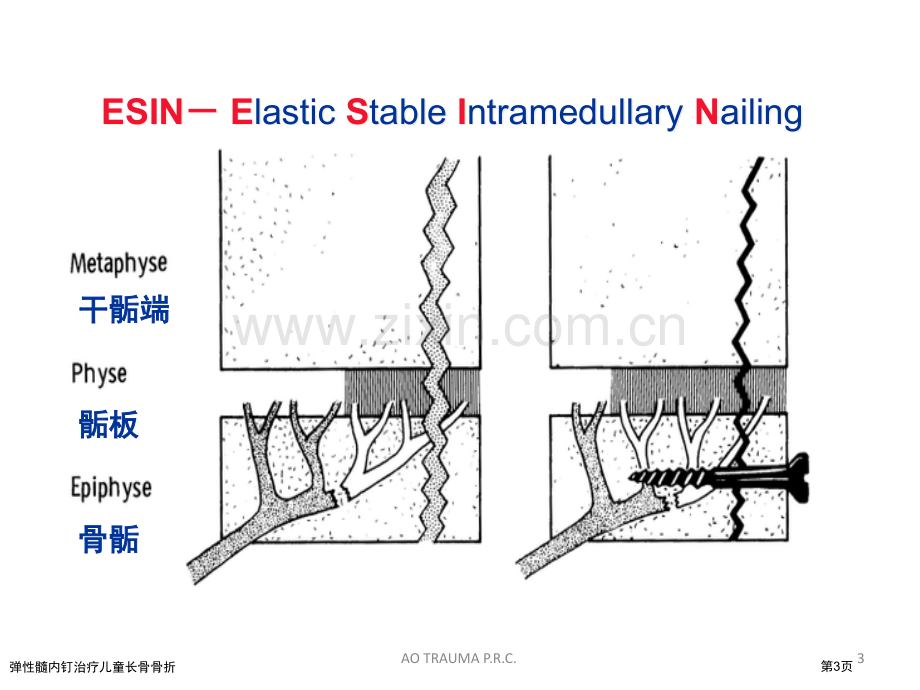 弹性髓内钉治疗儿童长骨骨折.pptx_第3页