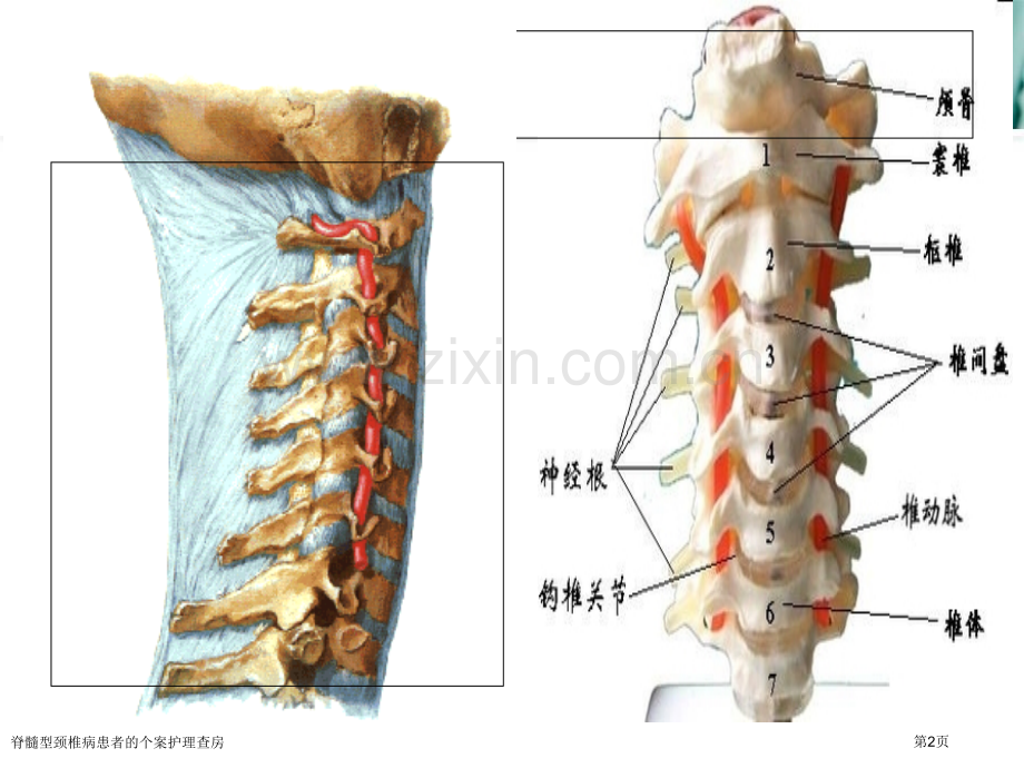 脊髓型颈椎病患者的个案护理查房.pptx_第2页