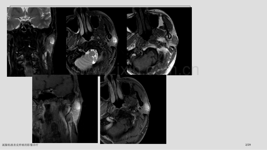 涎腺粘液表皮样癌的影像诊疗.pptx_第2页