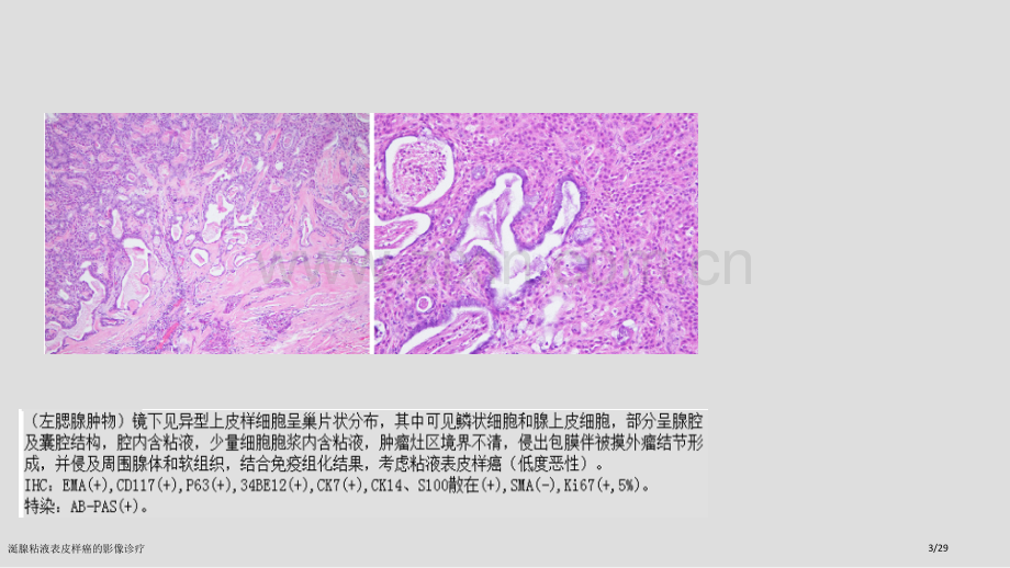 涎腺粘液表皮样癌的影像诊疗.pptx_第3页