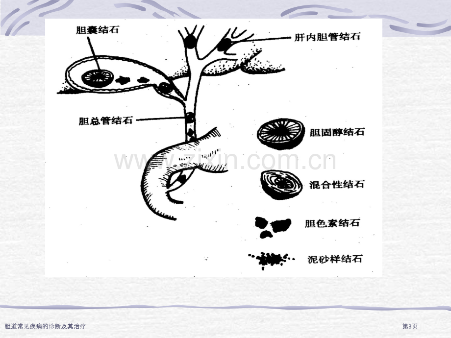 胆道常见疾病的诊断及其治疗.pptx_第3页