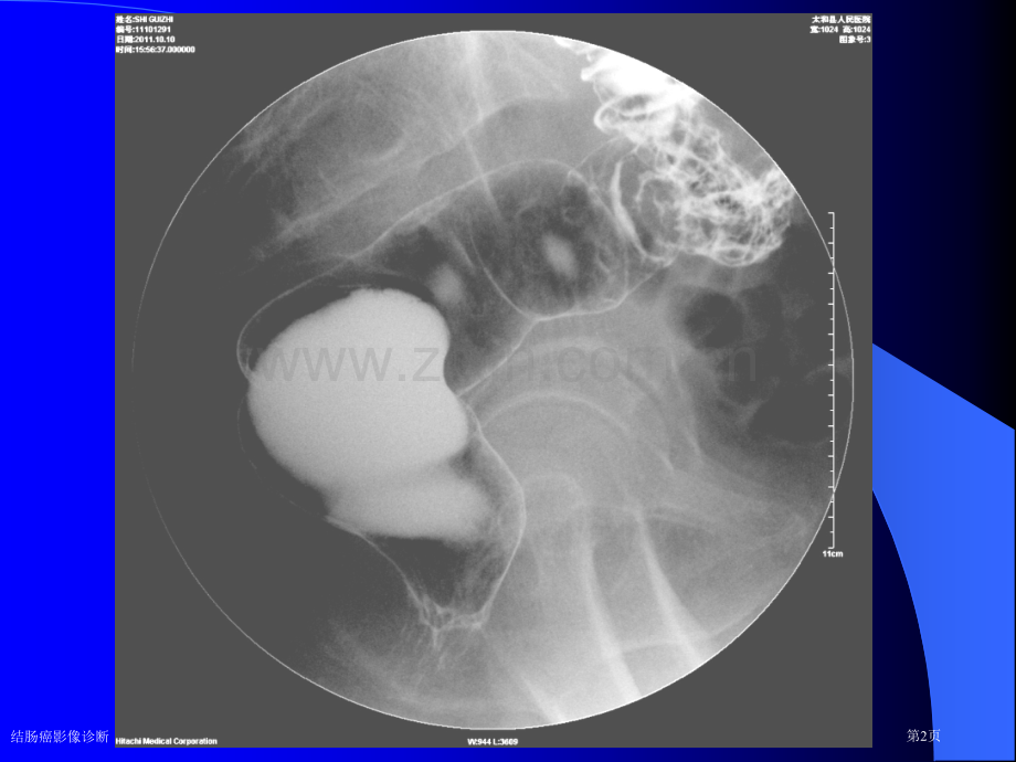 结肠癌影像诊断.pptx_第2页