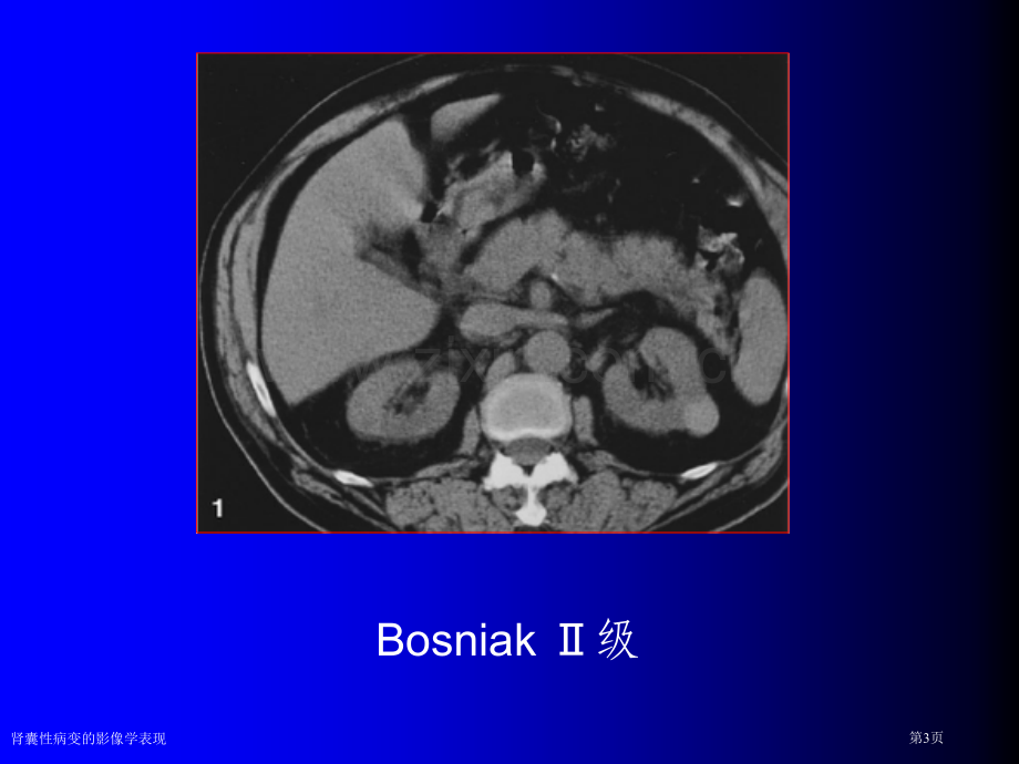 肾囊性病变的影像学表现专家讲座.pptx_第3页