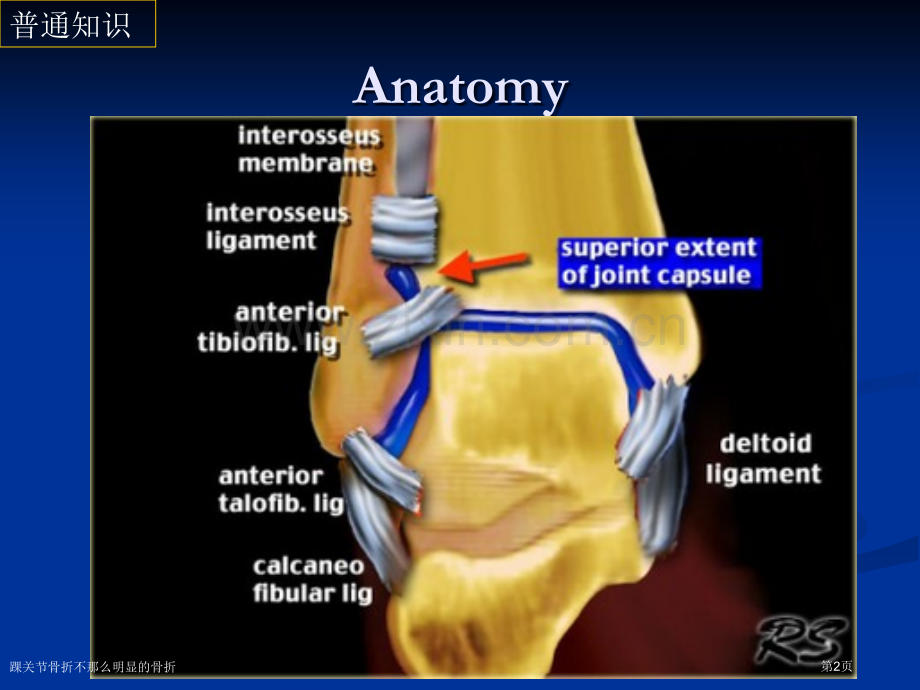 踝关节骨折不那么明显的骨折-.pptx_第2页