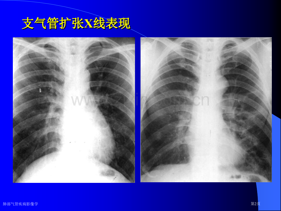 肺部气管疾病影像学专家讲座.pptx_第2页