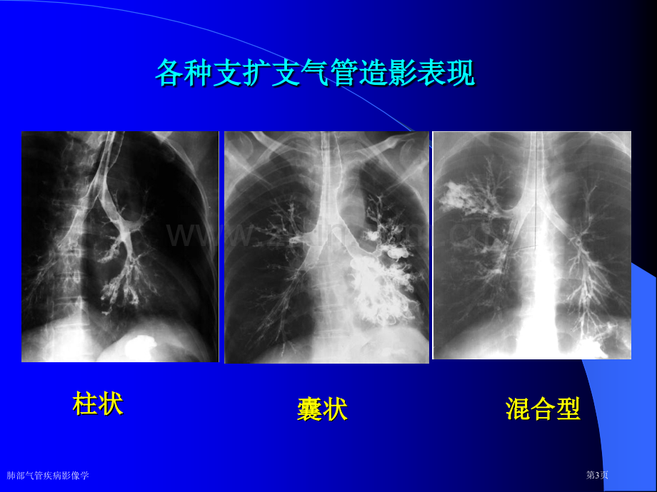 肺部气管疾病影像学专家讲座.pptx_第3页