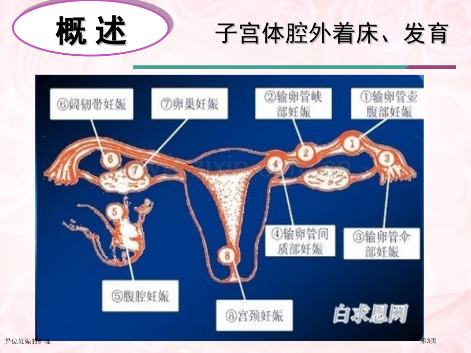 异位妊娠的护理专家讲座.pptx_第3页