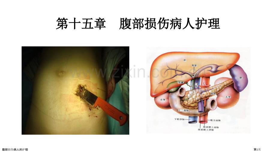 腹部损伤病人的护理.pptx_第1页