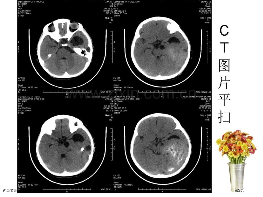 神经节细胞胶质瘤专家讲座.pptx_第2页