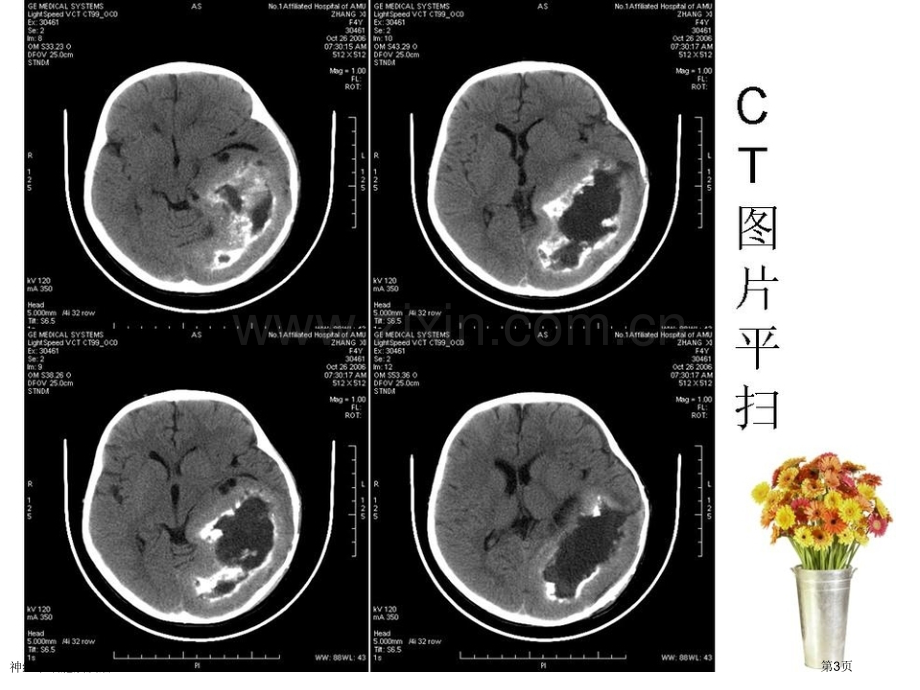 神经节细胞胶质瘤专家讲座.pptx_第3页