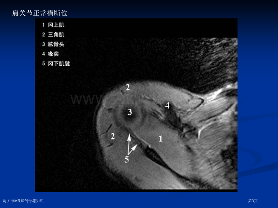 肩关节MR解剖专题知识.pptx_第3页