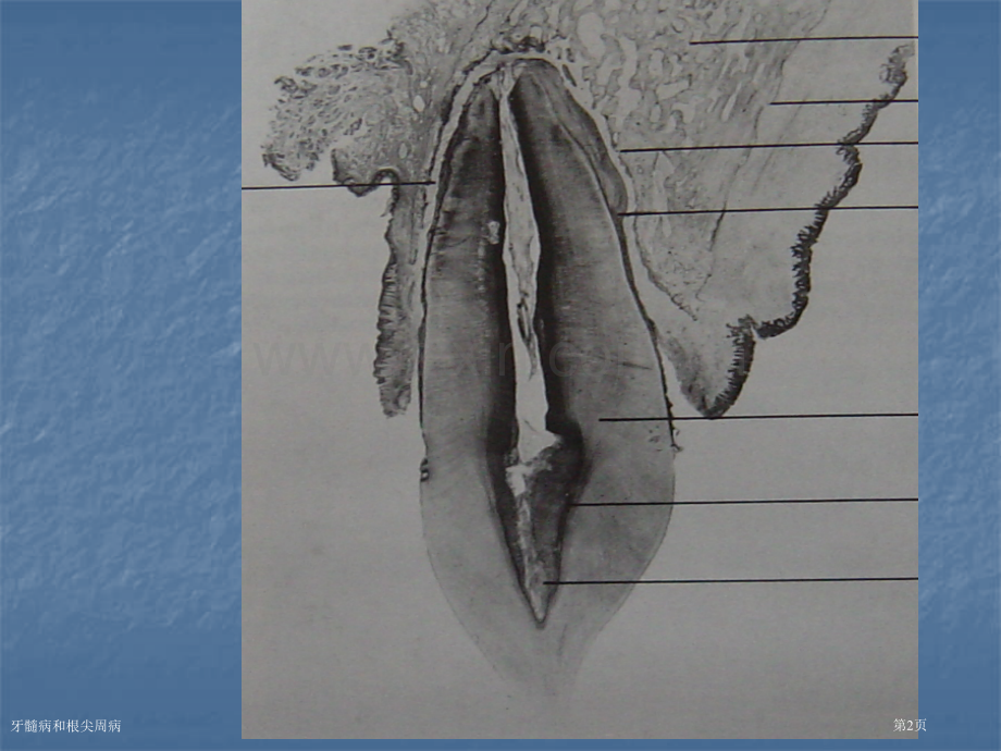 牙髓病和根尖周病专家讲座.pptx_第2页