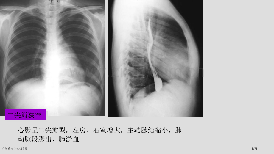 心脏病专业知识宣讲.pptx_第3页