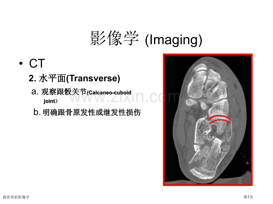 跟骨骨折影像学.pptx_第1页