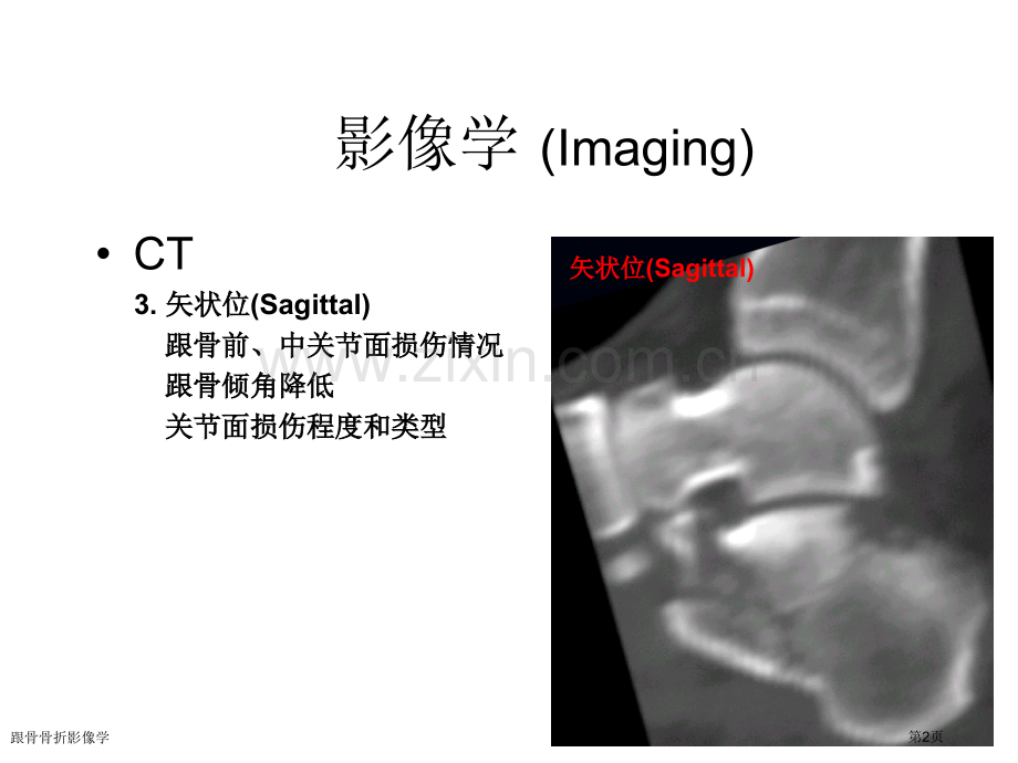 跟骨骨折影像学.pptx_第2页