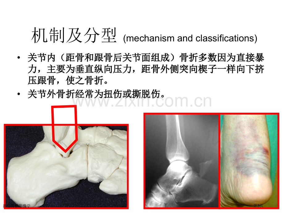 跟骨骨折影像学.pptx_第3页