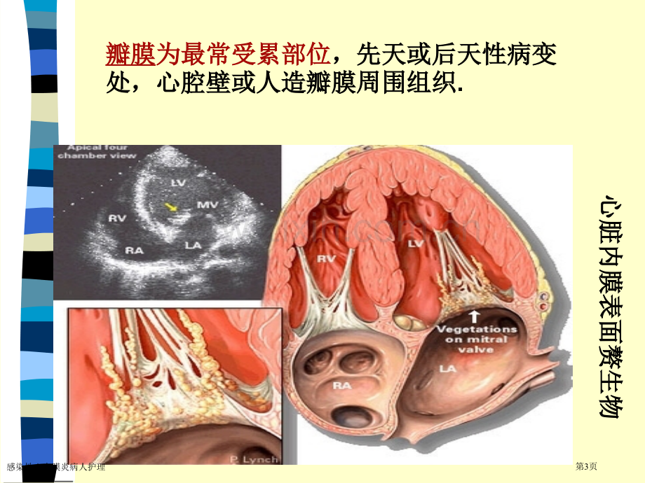 感染性心内膜炎病人护理.pptx_第3页