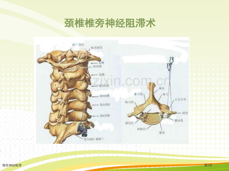 椎旁神经阻滞.pptx_第3页