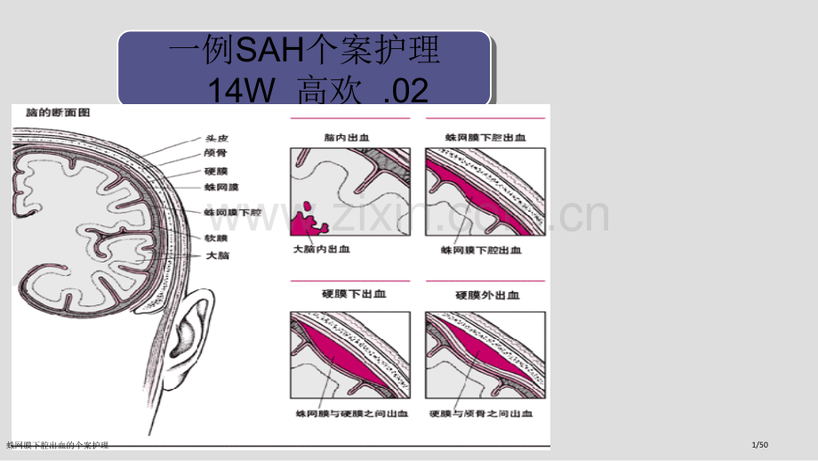 蛛网膜下腔出血的个案护理.pptx_第1页