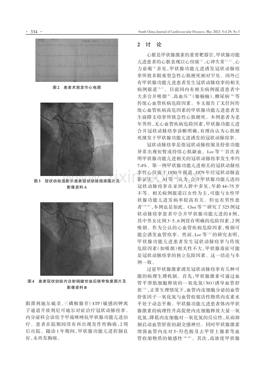 甲状腺功能亢进症诱发冠状动脉前降支痉挛所致急性心肌梗死1例.pdf_第2页