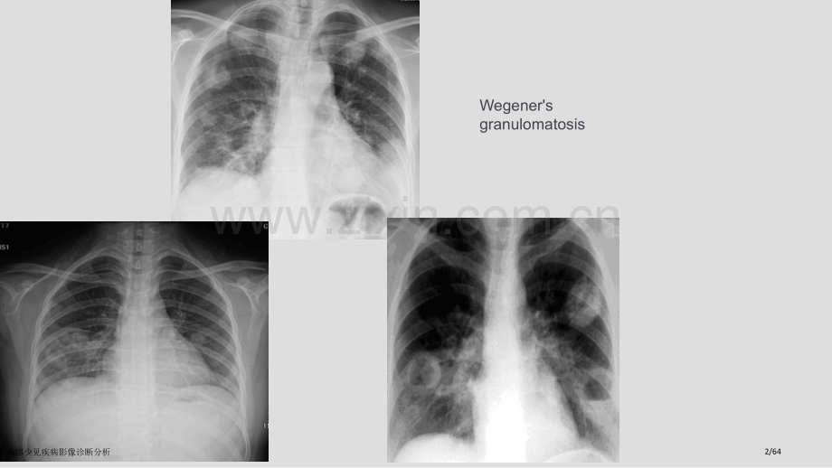 胸部少见疾病影像诊断分析.pptx_第2页