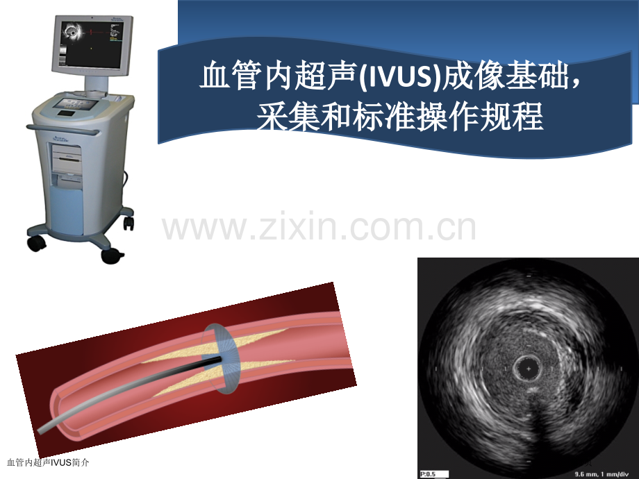 血管内超声IVUS简介.pptx_第1页