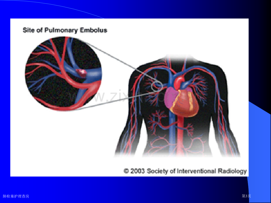 肺栓塞护理查房专家讲座.pptx_第3页