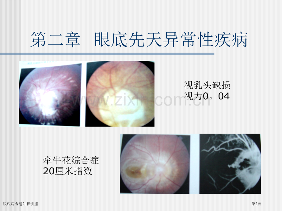 眼底病专题知识讲座专家讲座.pptx_第2页