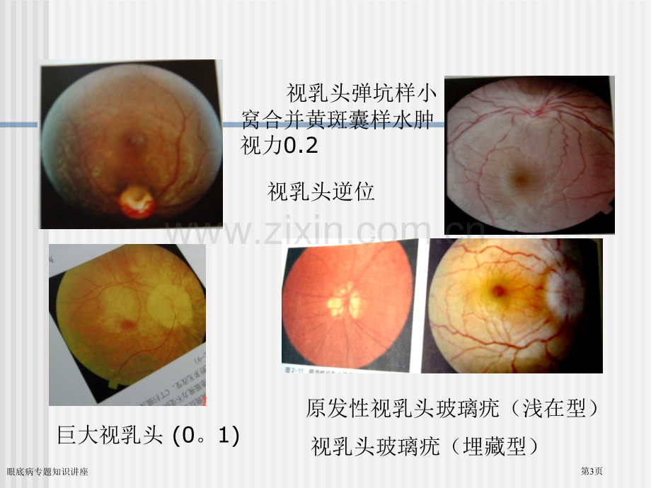 眼底病专题知识讲座专家讲座.pptx_第3页