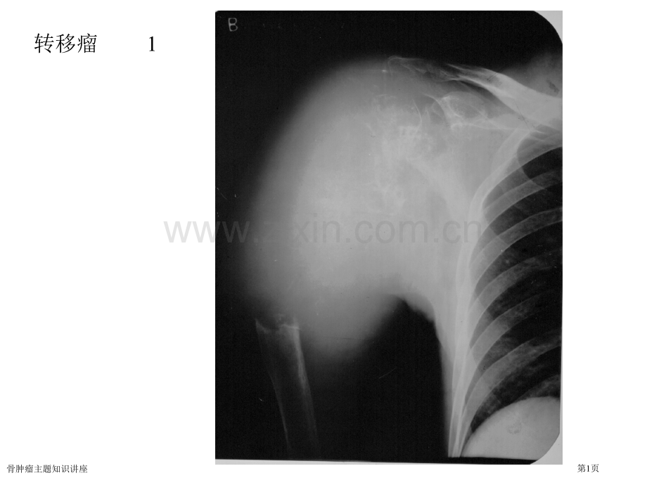 骨肿瘤主题知识讲座.pptx_第1页