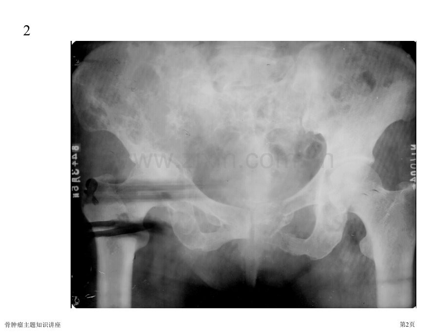 骨肿瘤主题知识讲座.pptx_第2页
