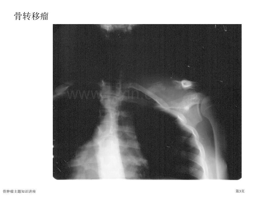 骨肿瘤主题知识讲座.pptx_第3页