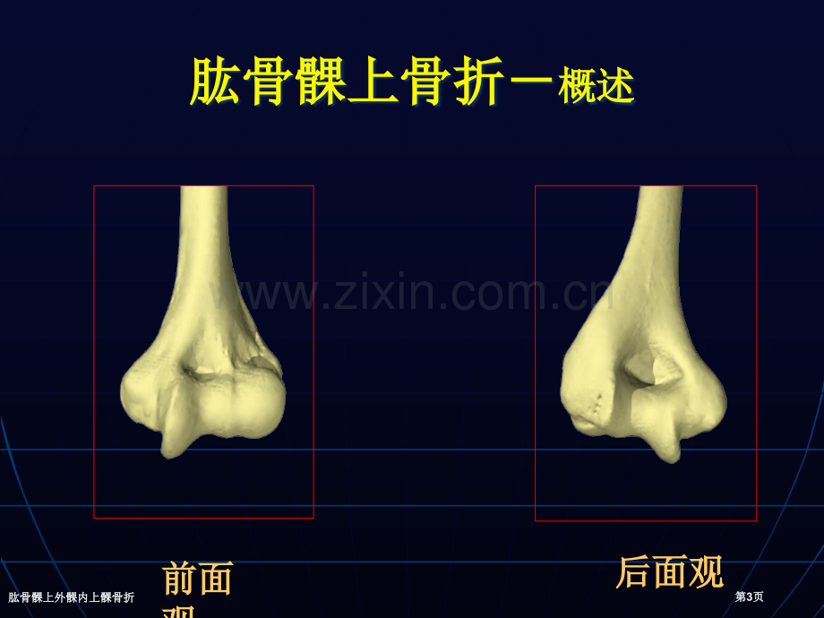 肱骨髁上外髁内上髁骨折.pptx_第3页