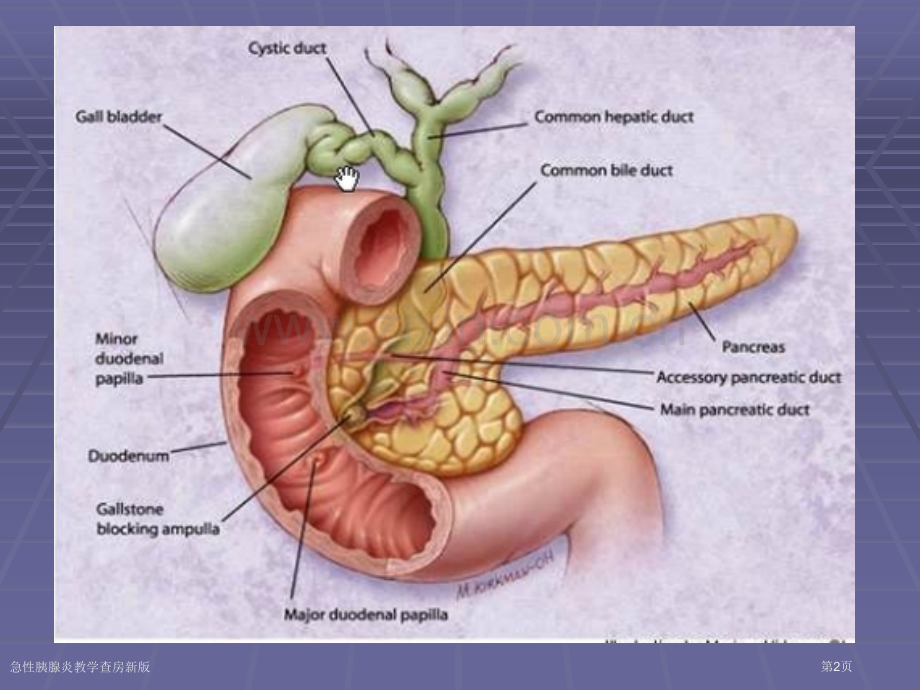 急性胰腺炎教学查房新版.pptx_第2页