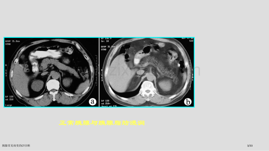 胰腺常见病变的CT诊断.pptx_第3页