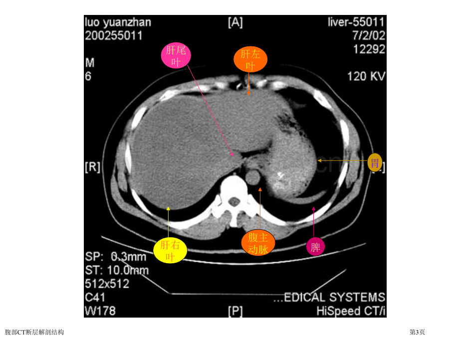 腹部CT断层解剖结构.pptx_第3页
