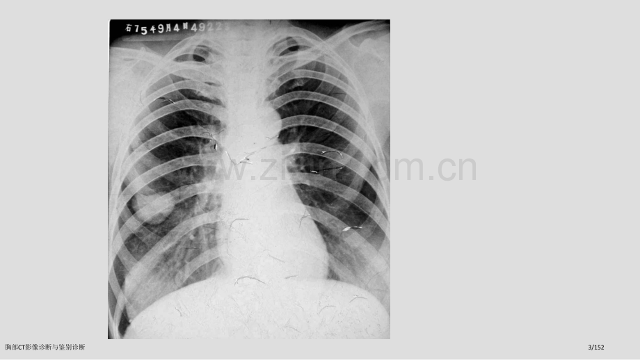 胸部CT影像诊断与鉴别诊断.pptx_第3页