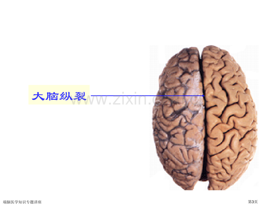 端脑医学知识专题讲座专家讲座.pptx_第3页