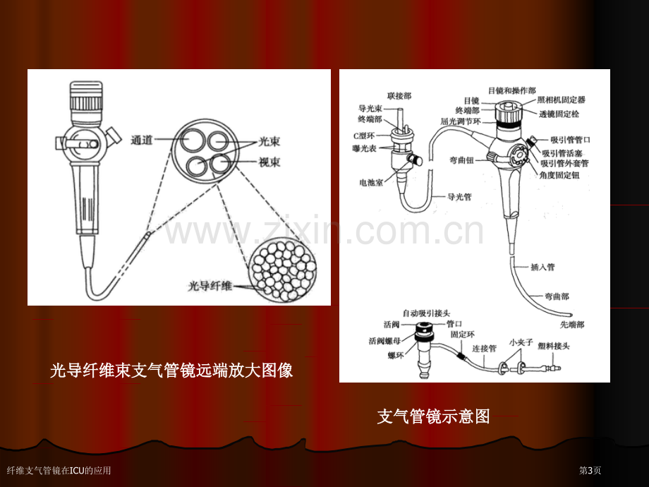 纤维支气管镜在ICU的应用.pptx_第3页