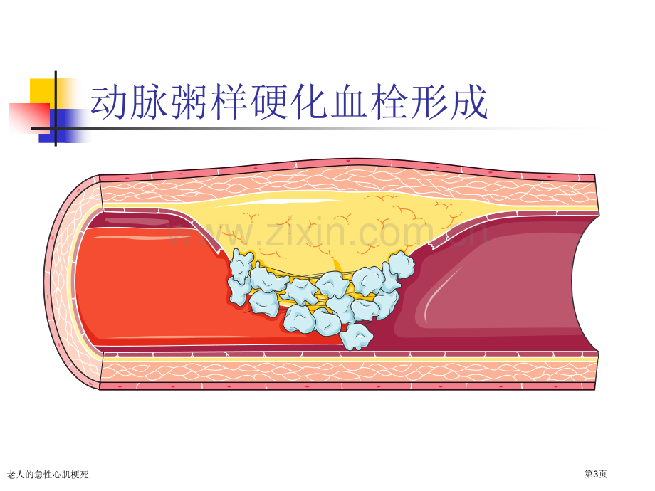 老人的急性心肌梗死专家讲座.pptx_第3页