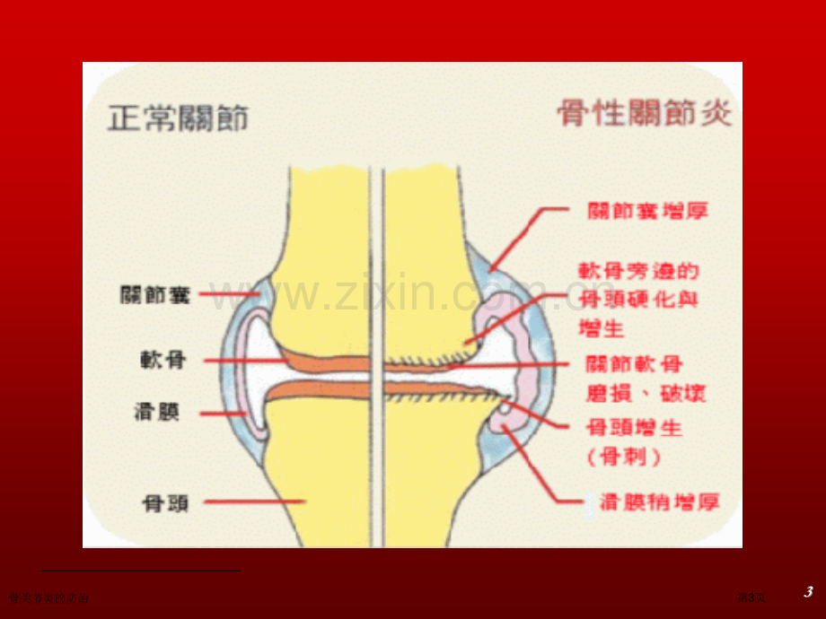 骨关节炎的防治.pptx_第3页