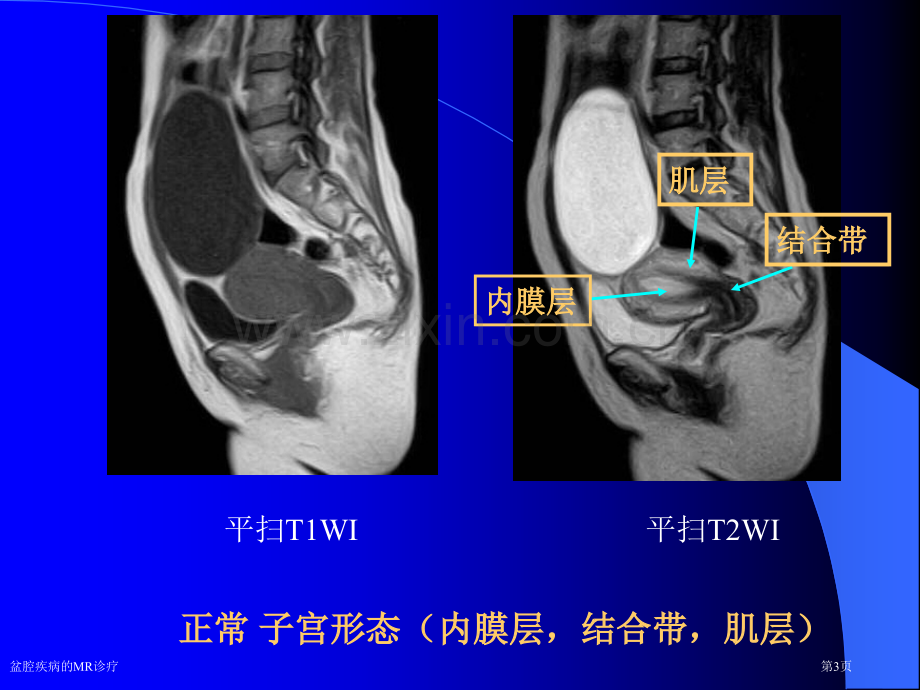 盆腔疾病的MR诊疗.pptx_第3页