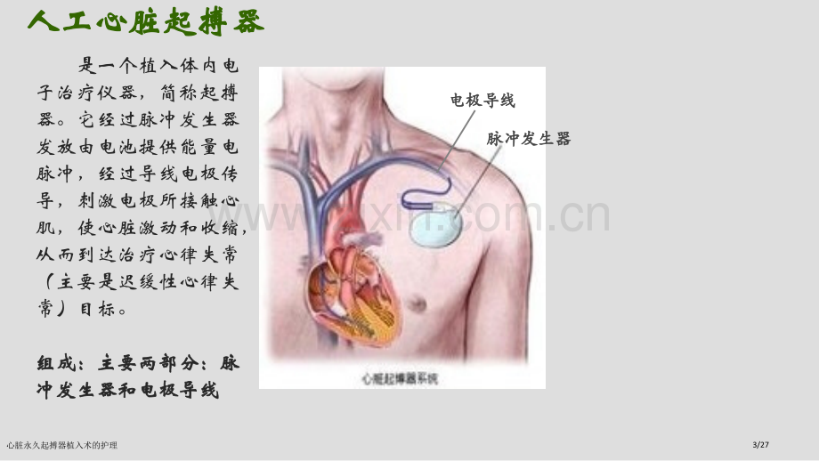 心脏永久起搏器植入术的护理.pptx_第3页