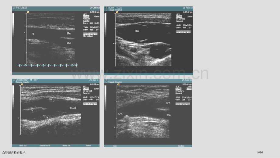 血管超声检查技术.pptx_第3页