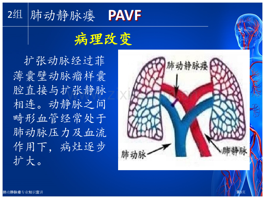 肺动静脉瘘专业知识宣讲.pptx_第3页