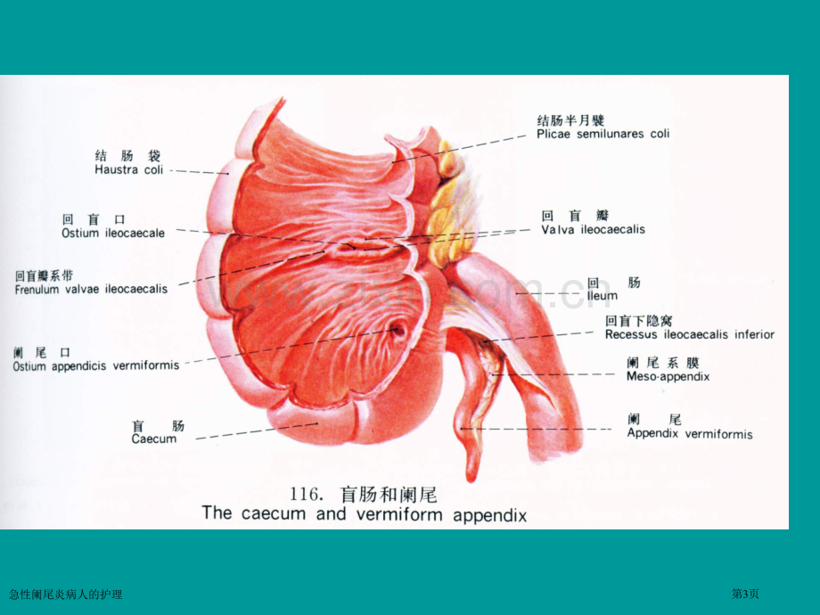 急性阑尾炎病人的护理专家讲座.pptx_第3页