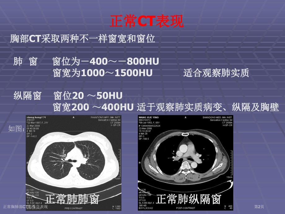 正常胸肺部CT影像学表现专家讲座.pptx_第2页