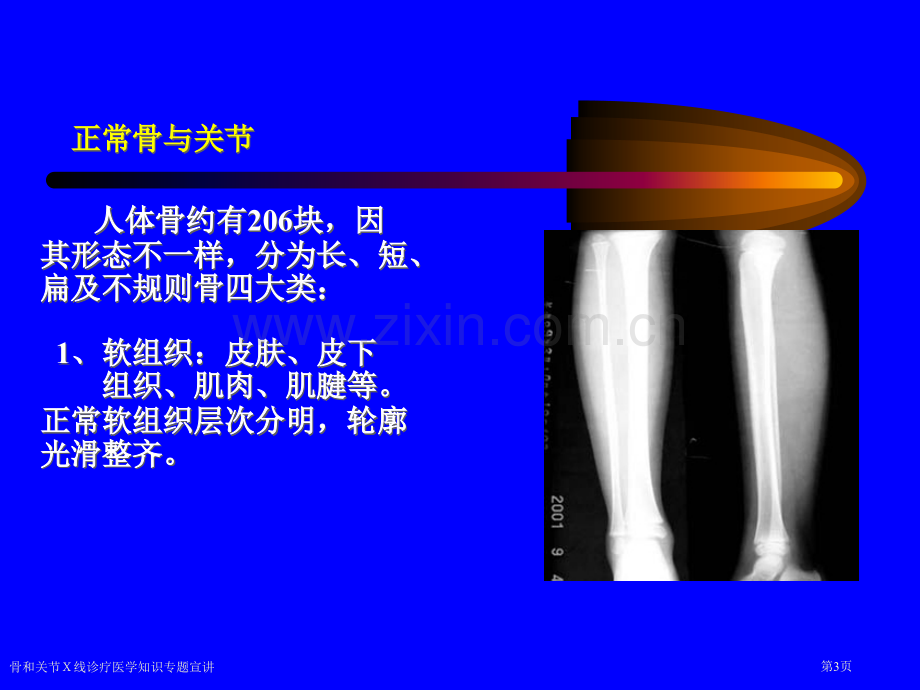 骨和关节X线诊疗医学知识专题宣讲专家讲座.pptx_第3页