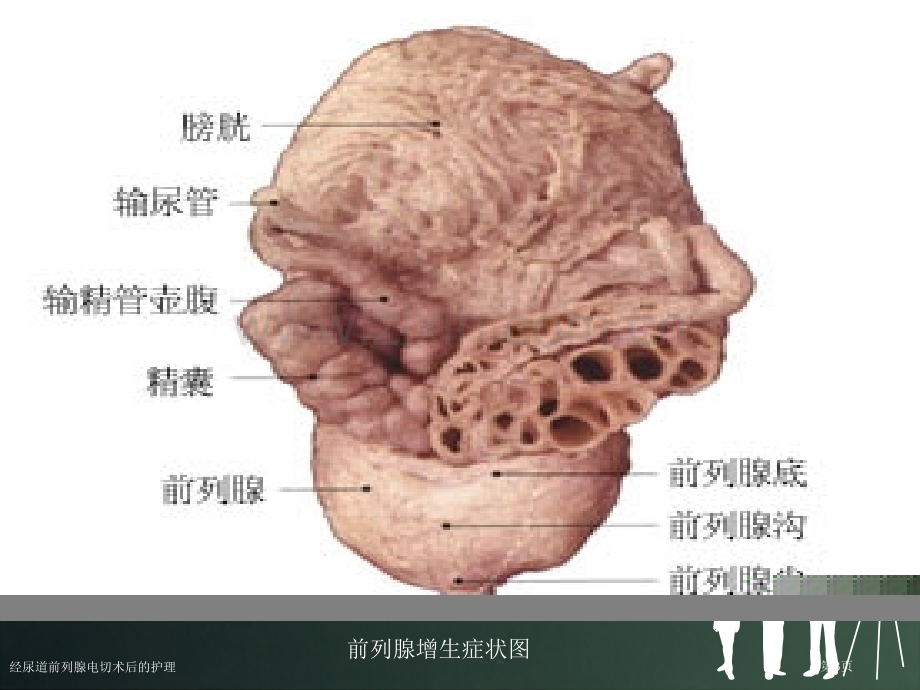 经尿道前列腺电切术后的护理.pptx_第3页